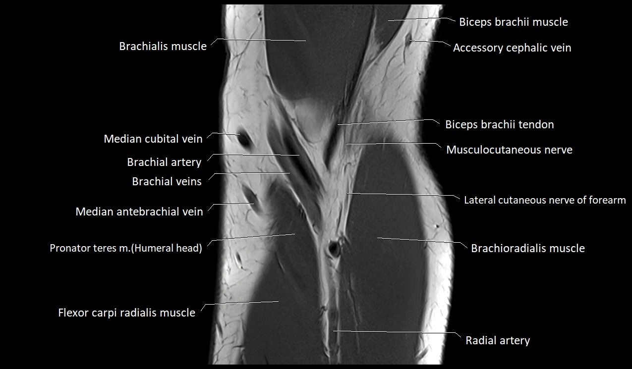 Elbow coronal anatomy image  cross sectional 3T MRI image 7.webp